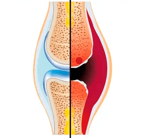 A estrutura dunha articulación sa e desgastada chamada tecido cartilaginoso e líquido sinovial