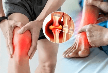 Esquema para aplicar xel Icexin na zona da articulación do xeonllo e do pé